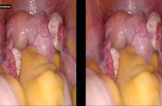 3D MYOMECTOMY