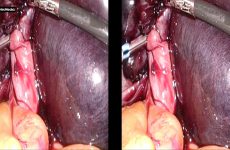 3D PVR Mumbai twisted cyst 2016