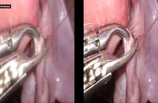 3D recanalisation 2016 Dr Modi
