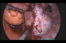 Bilateral Choclate cyst removal with R V Nodule excision