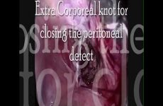 Cervical broad ligament myoma Sujal Munshi