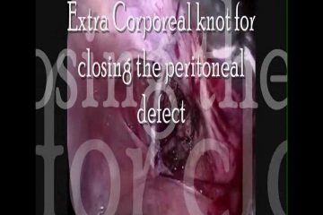 Cervical broad ligament myoma Sujal Munshi