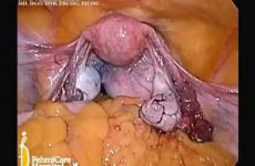 CERVICAL MYOMECTOMY