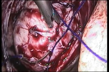CERVICAL MYOMECTOMY Renu Gehlot