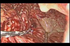 Diagnostic Laparoscopy & Proceed for chemical Peritonitis