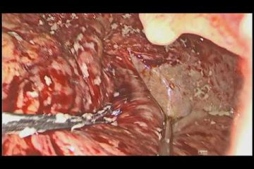 Diagnostic Laparoscopy & Proceed for chemical Peritonitis