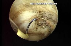 Dr Sanket Pisat deep submucous myoma resection