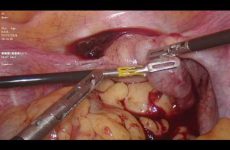 FIMBRIAL EXPRESSION OF TUBAL ECTOPIC PREGNANACY