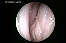 HYSTEROSCOPY