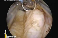HYSTEROSCOPY ENDOMETRIAL POLYPECTOMY