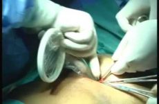 INSERTION OF WOUND RETRACTOR AND GLOVE