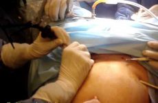 LAPAROSCOPIC CREATION OF NEO VAGINA