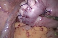 Laparoscopic Myomectomy + Endobag Morsafe Morcellation