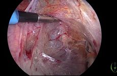 Laparoscopic myomectomy of large and oddly positioned myomas with uterine artery ligation at orig