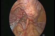 Laparoscopic Pectopexy for vault prolapse