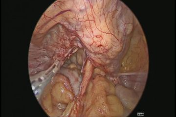 Laparoscopic Pectopexy for vault prolapse