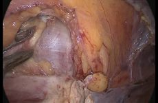 LAPAROSCOPIC PECTOPEXY VS SACROPEXY ALONG WITH TLH IN 3rd DEGREE UV PROLAPSE