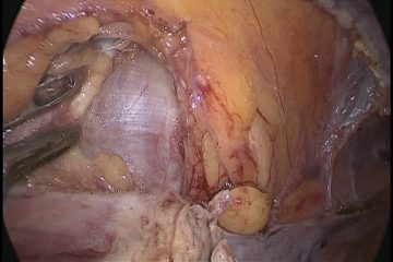 LAPAROSCOPIC PECTOPEXY VS SACROPEXY ALONG WITH TLH IN 3rd DEGREE UV PROLAPSE