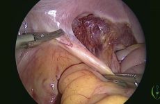 Laparoscopic Radical Hysterectomy with Pelvic Lymph Node Dissection