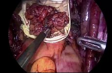Laparoscopic Repair of Obturator Nerve Injury in Pelvic Lymphadenectomy