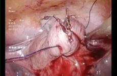 LESS MYOMECTOMY CLOSURE WITH BARBED SUTURE