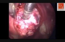 LESS MYOMECTOMY CLOSURE WITH ENDOSTICH