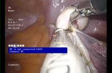 LESS PARTIAL OOPHRECTOMY