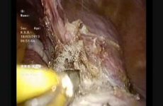 LESS TOTAL LAPAROSCOPIC HYSTERECTOMY