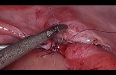MICRO SURGICAL TUBO TUBAL REANASTOMOSIS