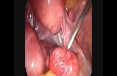 MORCELLATOMA