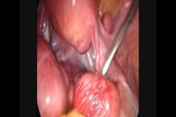 Morcellatoma Sujal Munshi