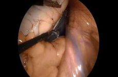MYOMECTOMY TEACHING