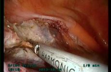 SUPRA CERVICAL HYSTERECTOMY WITH SACROCERVICOPEXY