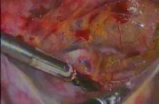 TECHNIQUE OF EXPLORING UTERINE ARTERY & URETER IN TOTAL LAPAROSCOPIC HYSTERECTOMY