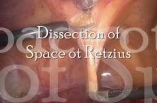 Techniques for prolapse surgery Sujal Munshi