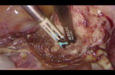 TOTAL LAPAROSCOPIC HYSTERECTOMY BY SIMPLE BIPOLAR