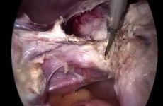 TOTAL LAPAROSCOPIC HYSTERECTOMY WITH HUGE PEDUNCULATED ROUND LIGAMENT MYOMA REMOVAL