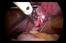TUBAL ECTOPIC PREGNANCY