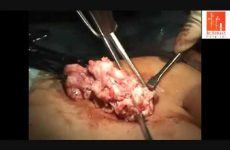 UMBLICAL MECHANICAL MORCELLATION