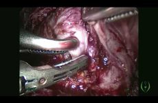 Utero Vesical Fistula Repair