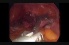 VAULT CLOSURE WITH ENDOSTICH