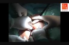 X CONE INSERTION