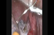 ADNEXAL TOSION WITH PREGNANCY