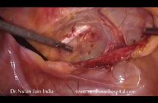 BURCH COLPOSUSPENSION  FOR STRESS URINARY INCONTINENCE