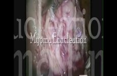 CERVICAL BROAD LIGAMENT MYOMA
