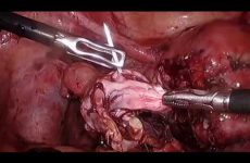 EXTENSIVE ENDOMETRIOSIS