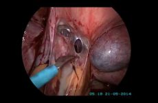 FOREIGN BODY UV POUCH