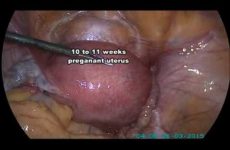 Laparoscopic cervical Encirclage by Hybrid Technique