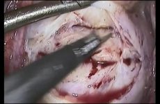 LAPAROSCOPIC CERVICAL MYOMECTOMY