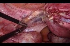 TLH WITH MULTIPLE MYOMA